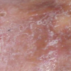 Image of Eczema