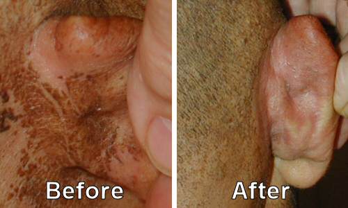 Before and After image of Radiation Burns treated with Aloe