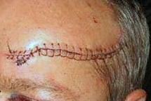 Stitches on someones forehead